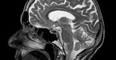 Após ‘falso derrame’, homem é diagnosticado com síndome rara Após ‘falso derrame’, homem é diagnosticado com síndome rara
