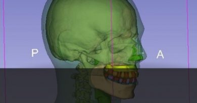 Radiologia: Pesquisador brasileiro desenvolve material para simulador de ossos e tecidos mais econômico Radiologia: Pesquisador brasileiro desenvolve material para simulador de ossos e tecidos mais econômico